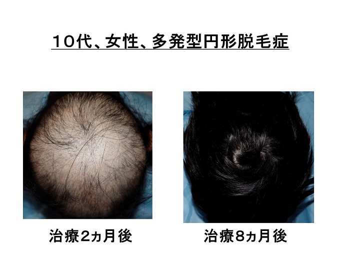 円形脱毛症　病院